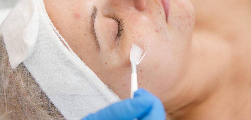 Diminish Clinic | Chemical Peel